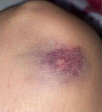 このアザは26日にできた物なのですが ディズニーシーのセンターオブジアー Yahoo 知恵袋