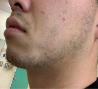 17歳で髭がこのように生えてるのはレアですか 1週間くらい剃ってな Yahoo 知恵袋