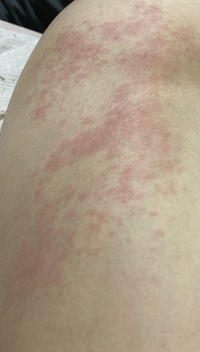 数日前から写真のような発疹が全身に出ています 腹部 太もも 膝 Yahoo 知恵袋
