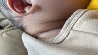 乳児湿疹について教えてください 生後5ヶ月の娘の首に急に湿疹がでました Yahoo 知恵袋