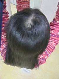 これはハゲですよね 代女性です たまたまハーフアップ Yahoo 知恵袋