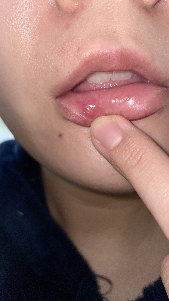 口唇ヘルペス に関するq A Yahoo 知恵袋