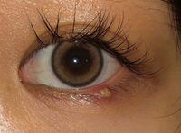 これはものもらいになりますか それともニキビですか 痒く Yahoo 知恵袋