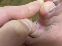 足の指の間がときどきこうなります 切れたり治ったりを繰り返します 左足だ Yahoo 知恵袋