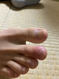 腫れ 足の指の付け根 足の指をぶつけた！すごく痛いけど骨折か見分ける方法ってあるの？