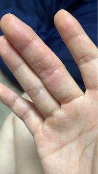 変更 以内に 荒らす 指 ひび割れ かゆみ Futomomo Diet Net