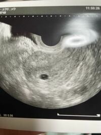 エコー写真です 現在5週5日ですがこれは双子でしょうか 胎嚢のなか Yahoo 知恵袋