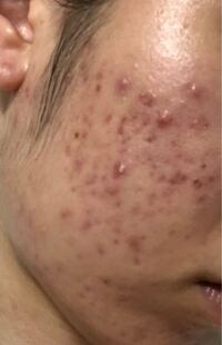 マスク生活になって 元々あまり肌荒れしなかったのにこんなにあれ Yahoo 知恵袋