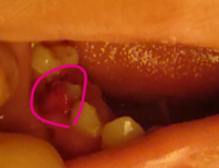 画像あり 先程虫歯だった所の歯が抜けました 柔らかい突起物な様 Yahoo 知恵袋