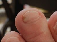 爪に茶色い点が二つできています なにかの病気でしょうか 今日 Yahoo 知恵袋