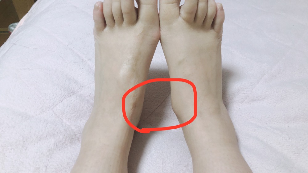 足首から下の形が左右で異なります 病院で見てもらったほうが良いでしょうか Yahoo 知恵袋