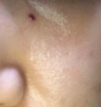 ニキビの面ぽう圧出について 昨日 皮膚科でニキビの面ぽう圧出をしました Yahoo 知恵袋