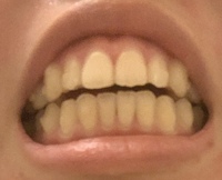 正しい噛み合わせ 私は去年からインビザラインで開咬と出っ歯 下 Yahoo 知恵袋