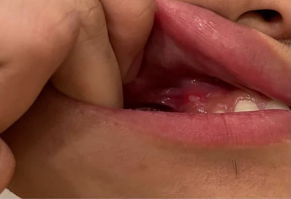 白いできもの 唇 に関するq A Yahoo 知恵袋