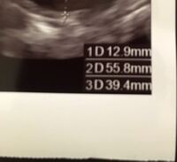 エコー写真の見方がわかりません 子宮のエコー 1d 2d Yahoo 知恵袋