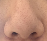 鼻の黒ずみが小さい頃から治らなく 蒸しタオル Duoで洗顔 酵素洗顔 鼻 Yahoo 知恵袋