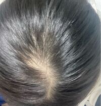 前髪と後ろ髪の分け目の真ん中 みたいなところなんですけどこれやばいで Yahoo 知恵袋