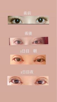 21年に2月24日に埋没法 目頭切開 目尻切開 グラマラス Yahoo 知恵袋