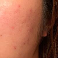 顔の片側だけ肌荒れする Ayuca Organic Health Beauty