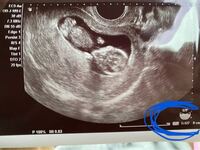 エコーの写真なのですが 青丸で印のある所に8cmとあるのですが これは赤 Yahoo 知恵袋