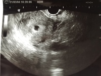 本日6週3日だったのですが 前回より胎嚢は大きくなっていたのですが リン Yahoo 知恵袋