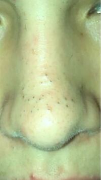 鼻の黒ずみ角栓についてです 写真あります 結構酸化 していて硬くて Yahoo 知恵袋