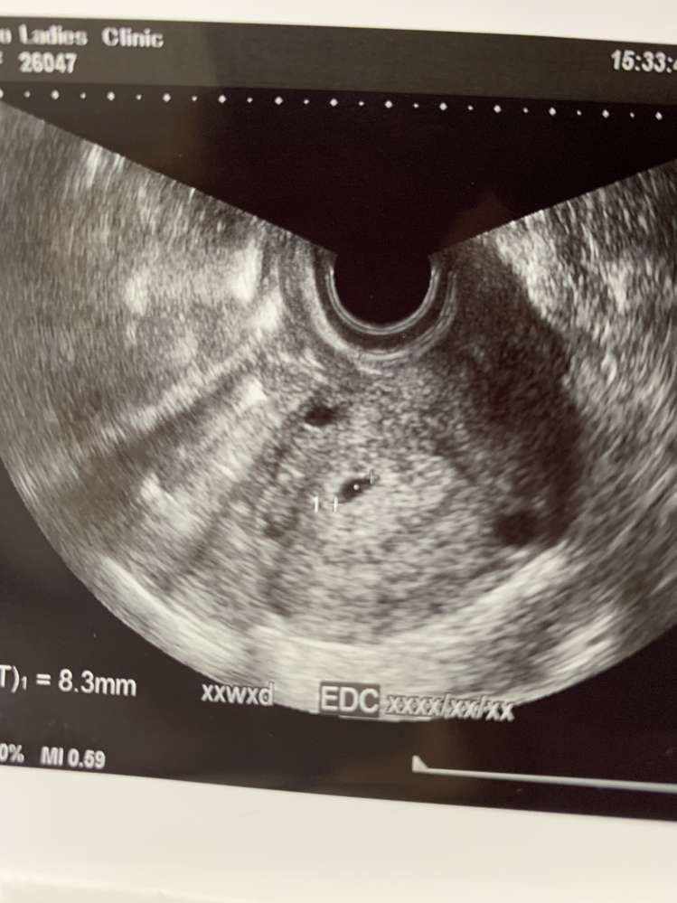 妊娠5週目4日です双子でしょうか それとも 血の塊 膀胱 次は3週間後な Yahoo 知恵袋