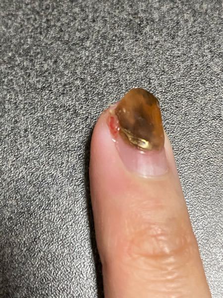 グロ注意です 3日前くらいに爪の横にあったささくれを抜いてしま Yahoo 知恵袋