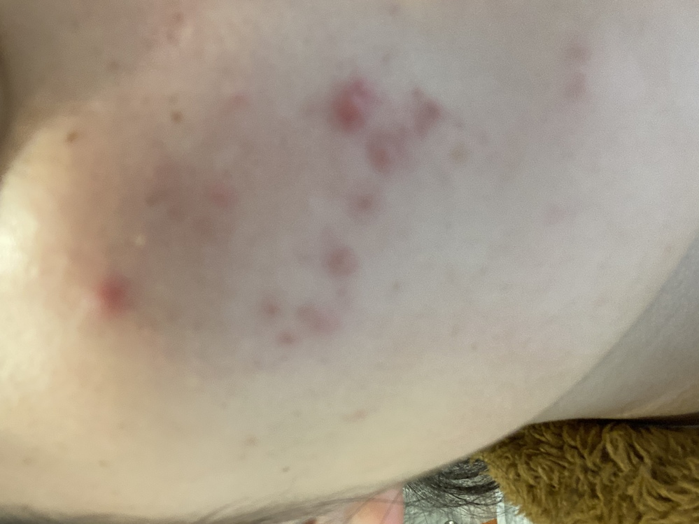 ニキビケア 解決済みの質問 Yahoo 知恵袋