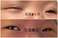 赤ちゃんのまぶたが二重から一重に 産まれたときは二重だったのに 3ヶ月頃か Yahoo 知恵袋