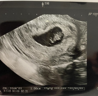 エコー写真について 現在妊娠7週目です 前回心拍も確認しており Yahoo 知恵袋