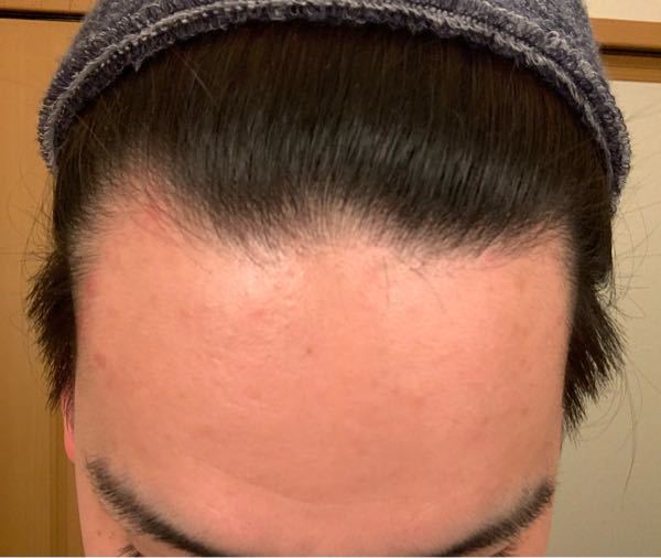 24歳男です これはハゲていますか あと生え際にニキビが出来るので Yahoo 知恵袋