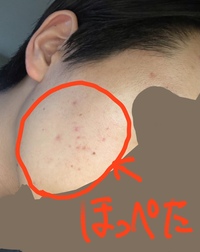 この赤ニキビどうやったら駆逐出来ますか 効果的な市販薬等教えて Yahoo 知恵袋