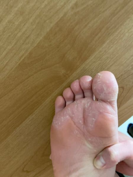 水虫以外 に関するq A Yahoo 知恵袋