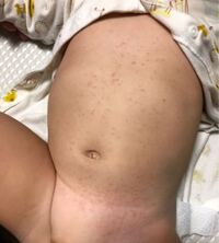 初めまして 9ヶ月の赤ちゃんのママです 金曜日から息子のお腹とビキ Yahoo 知恵袋