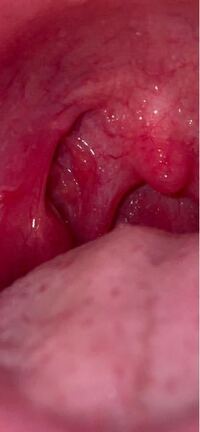 閲覧注意です 最近喉に違和感を感じます 痛いというか 詰まっている Yahoo 知恵袋