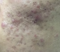 高1男子ですニキビ ニキビ跡で悩んでいますどう対処すべきですか Yahoo 知恵袋