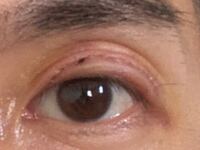 数年前に二重切開をしましたが ずっと傷跡が気になっていたので今 Yahoo 知恵袋