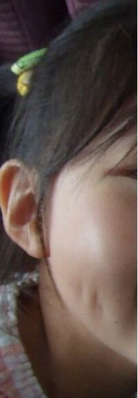 えくぼが片頬だけに２つあるのですが 変でしょうか Yahoo 知恵袋