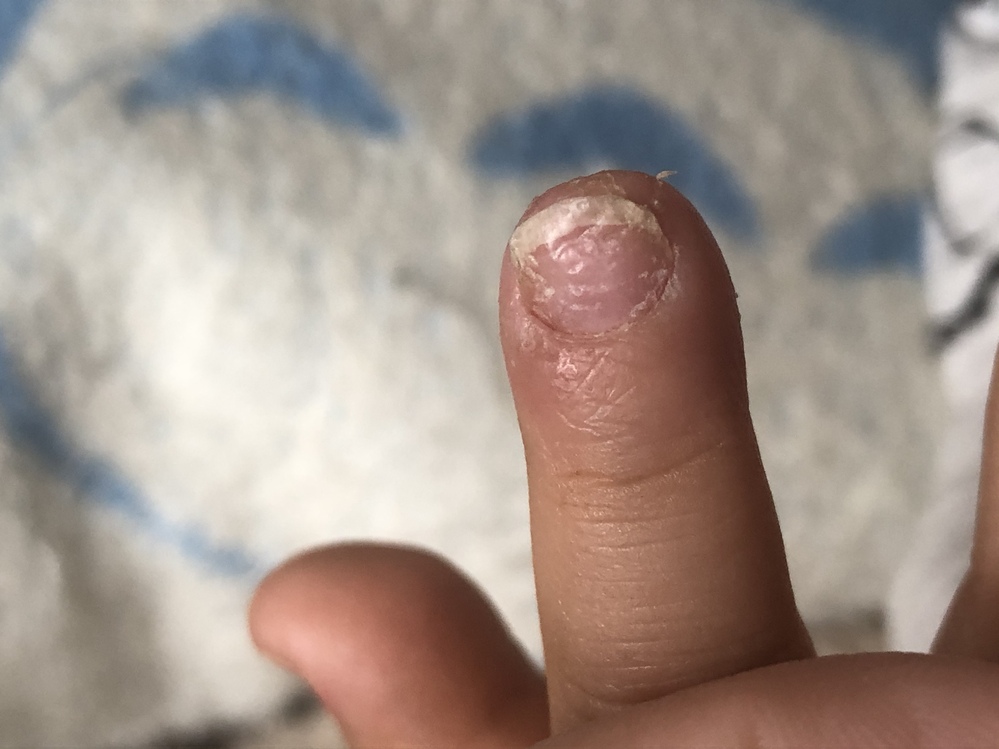 2歳児の子供の爪が分厚い 常にあかぎれ 良く分からず 小児科 Yahoo 知恵袋