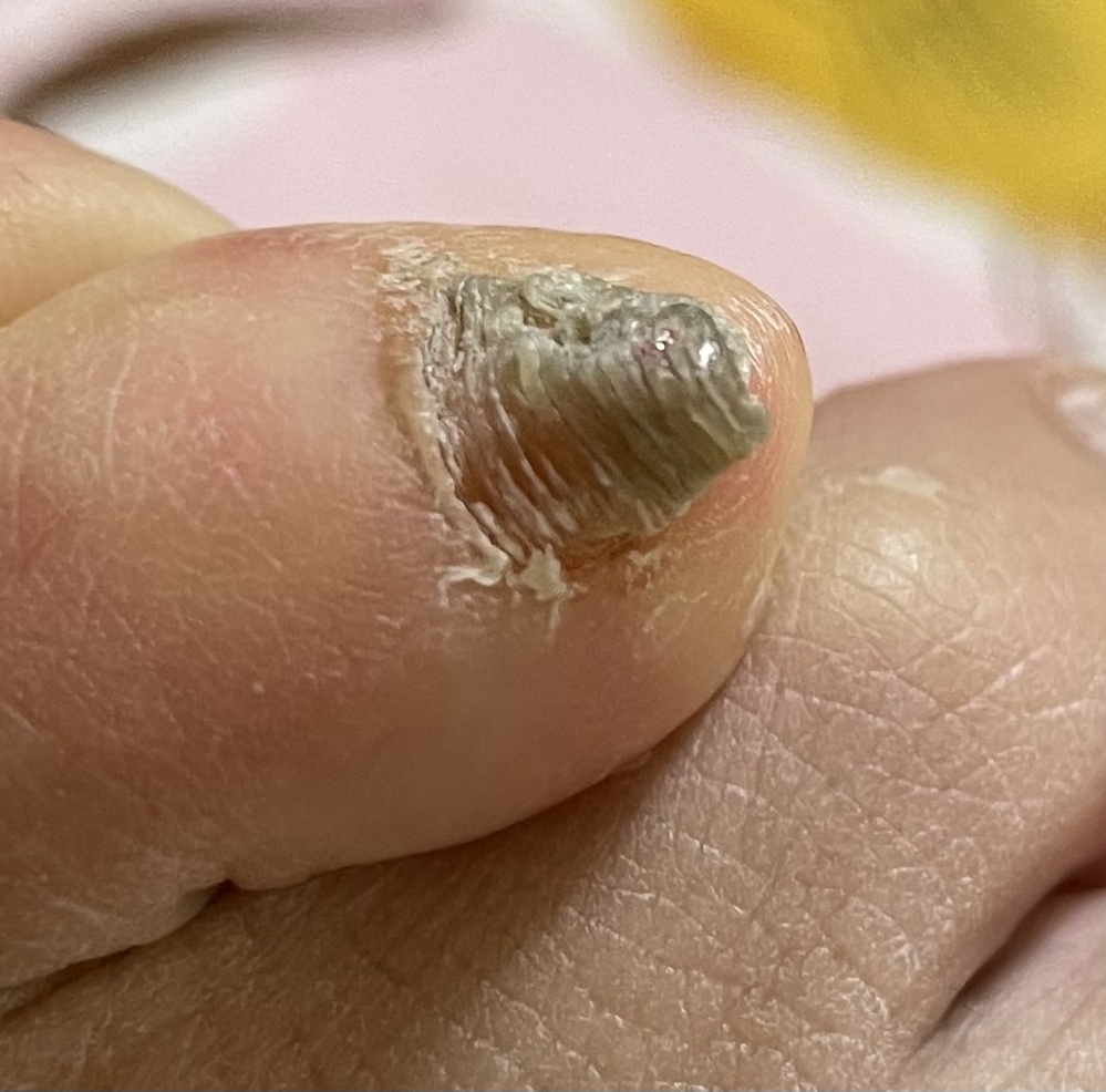 小指の爪がこのように 黒くて少し分厚くなっています なかなか切 Yahoo 知恵袋