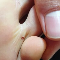 足に急に真っ黒なホクロのような物ができました 引っ張ったらポロ Yahoo 知恵袋