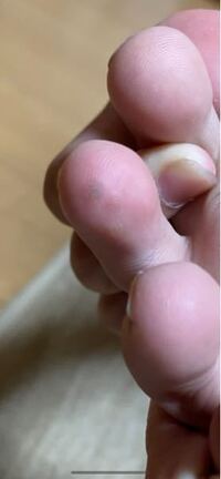 足にブツブツができていました 最近魚の目がよくできていたのですがそれとは Yahoo 知恵袋