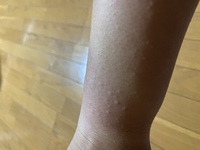 ３日前くらいから夜になると足 腕がとてもかゆくて小さなぶつぶつが広範囲に Yahoo 知恵袋