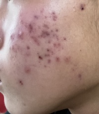 これって紫ニキビですか それともニキビ跡ですか 教えて下さい Yahoo 知恵袋