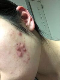 観覧注意 ニキビが治りませんヾ W ﾉこのよう Yahoo 知恵袋