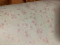 昨日家に帰ってきてから 蕁麻疹のような赤い点々ができ1日経って Yahoo 知恵袋