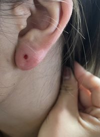 今日ピアスを開けました 消毒としてゲンタシンを病院で貰ったので Yahoo 知恵袋