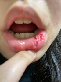 閲覧注意 このような傷 凹み はどのくらい Yahoo 知恵袋