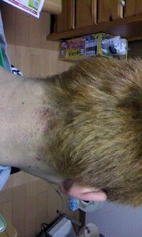 ブリーチで髪を染めたら首にこのようなのができてしまい痛いです Yahoo 知恵袋